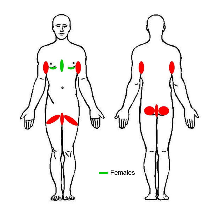 Dermesthetic - Hidradenitis Suppurativa (HS) also known as acne inversa is  a skin disease that usually begins as pimples in the armpits (usually both  armpits) or in the groin (pubic area). It