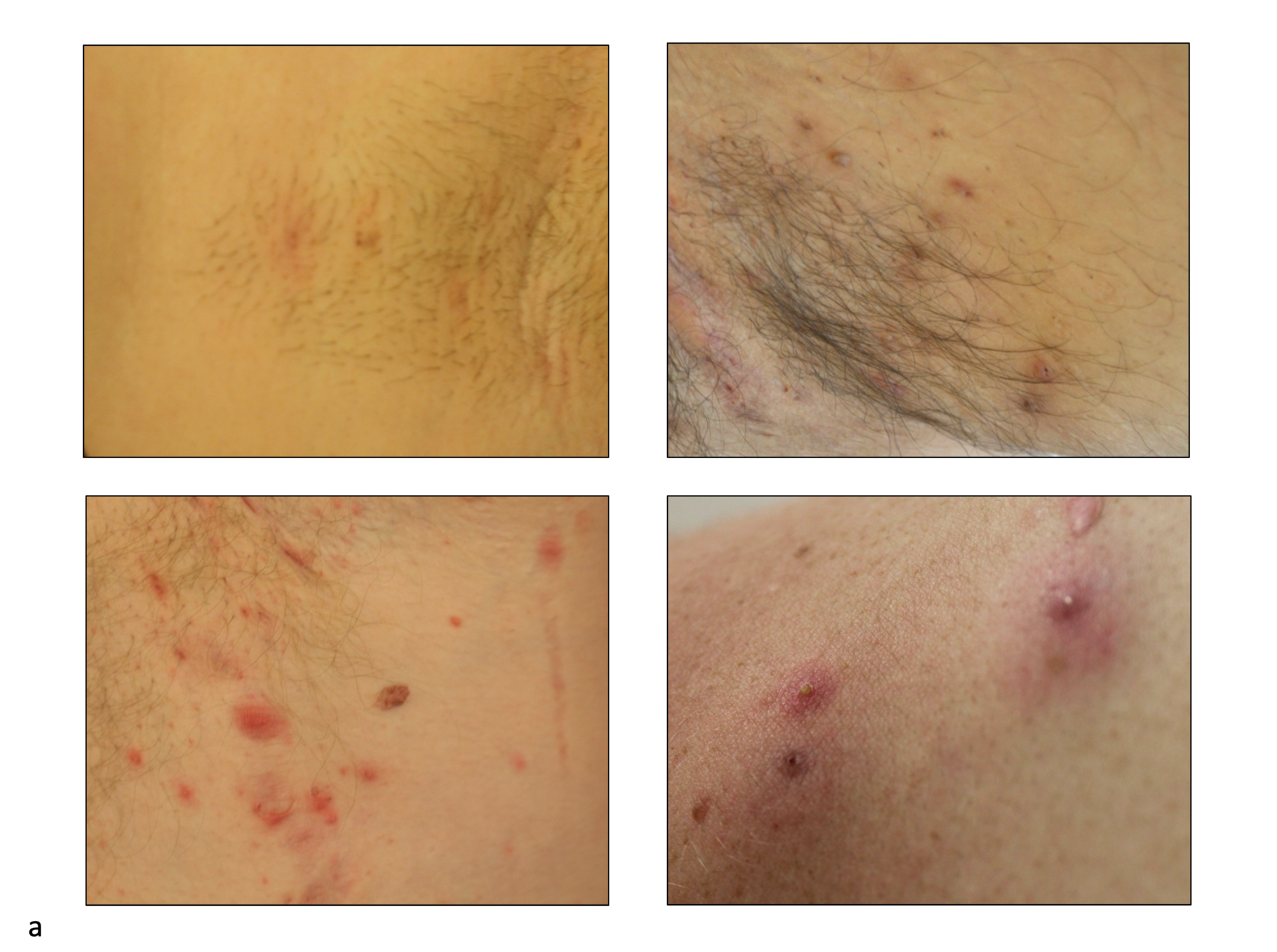 Folliculitis Groin Female