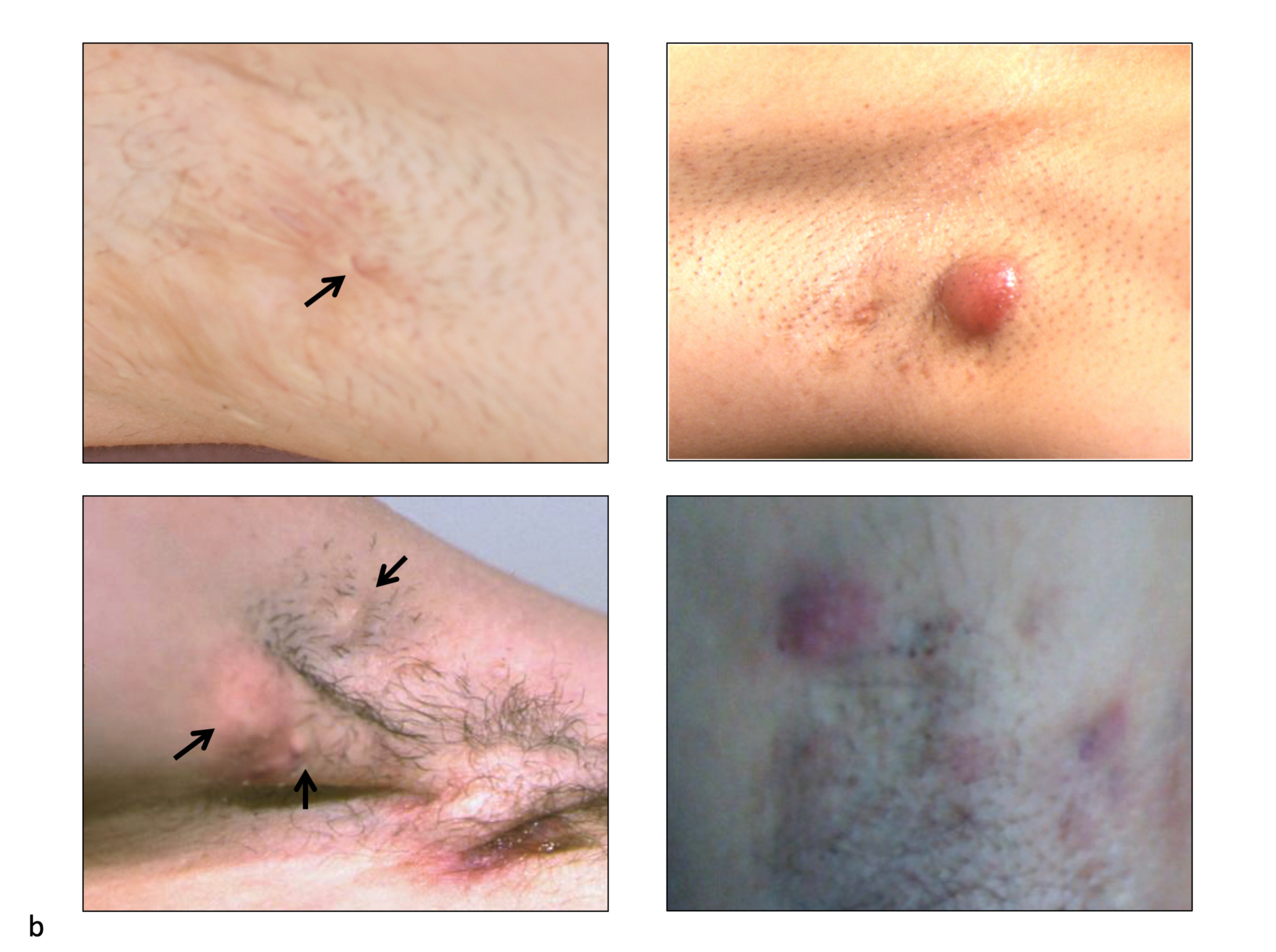 nodule skin lesion