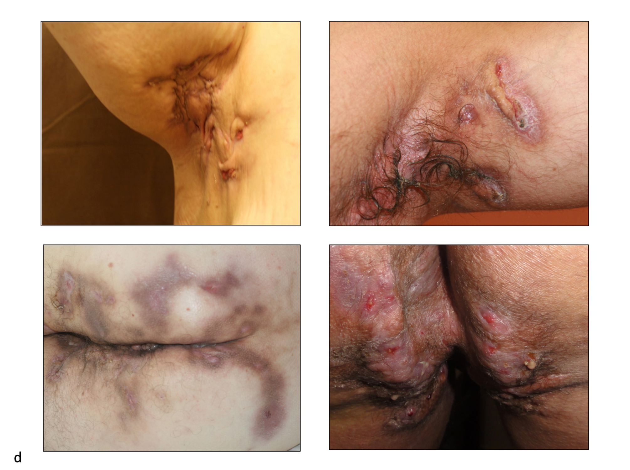 hidradenitis suppurativa scalp